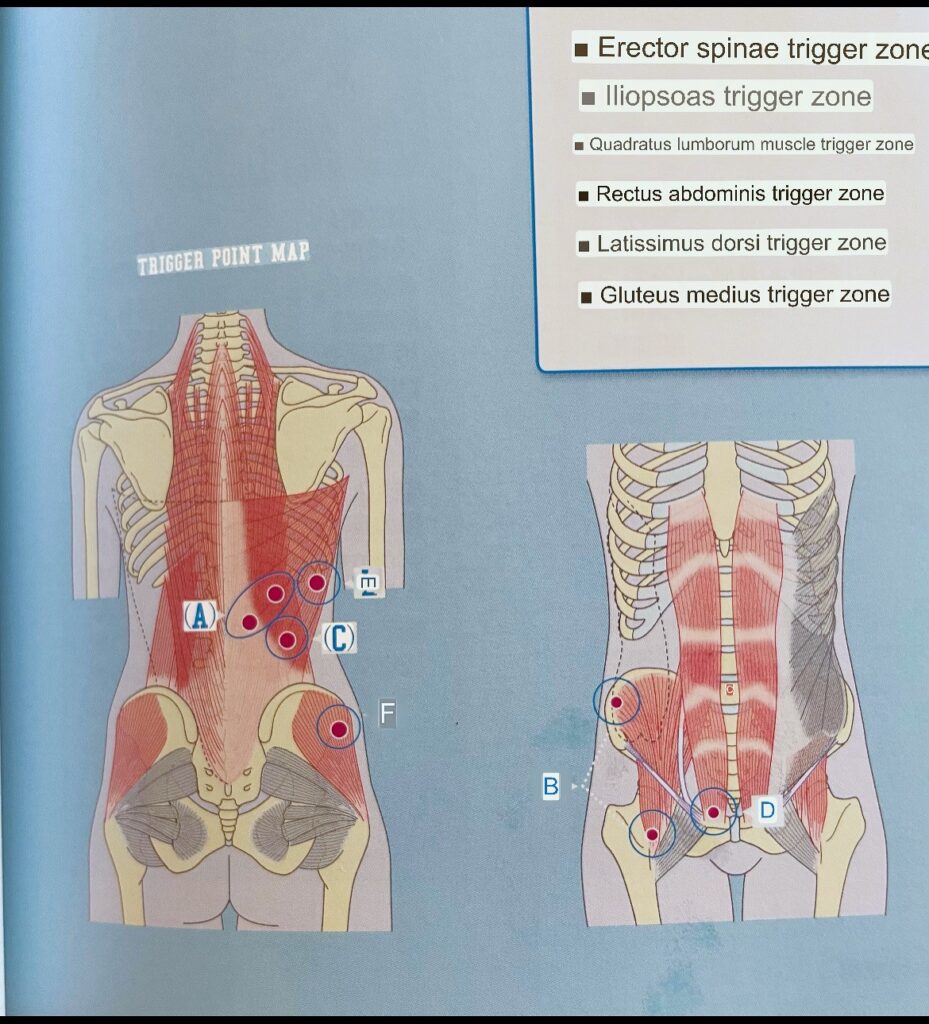 low back pain; trigger points, 